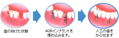 歯の抜けた状態→AQBインプラントを埋め込みます→人工の歯をかぶせます。